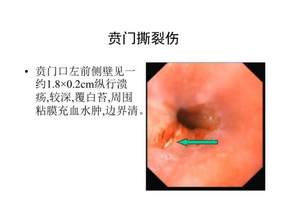 典型内镜图片学习资料_第3页