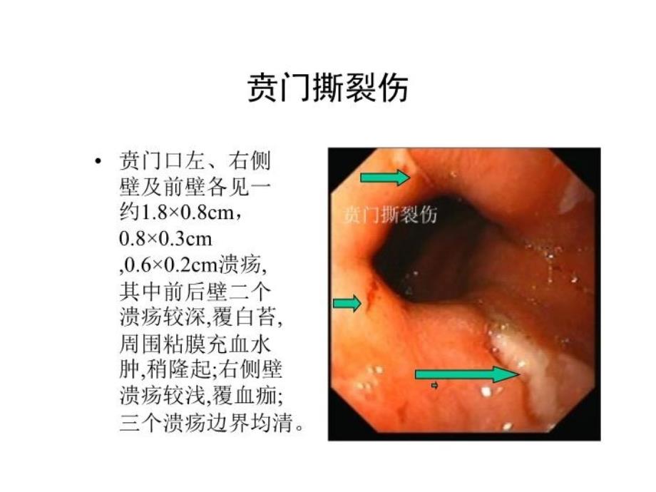典型内镜图片学习资料_第4页