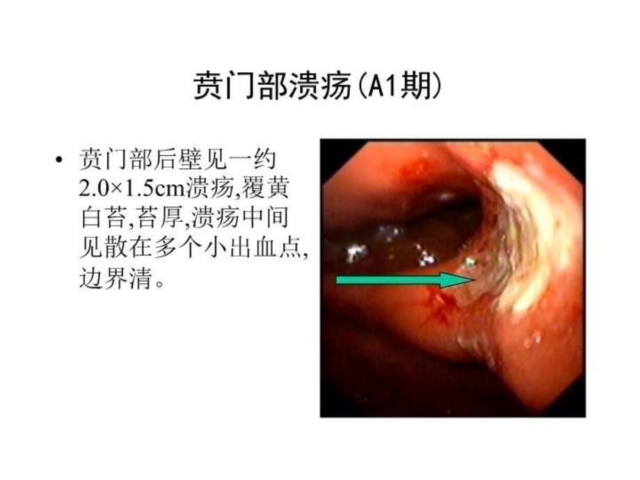 典型内镜图片学习资料_第5页