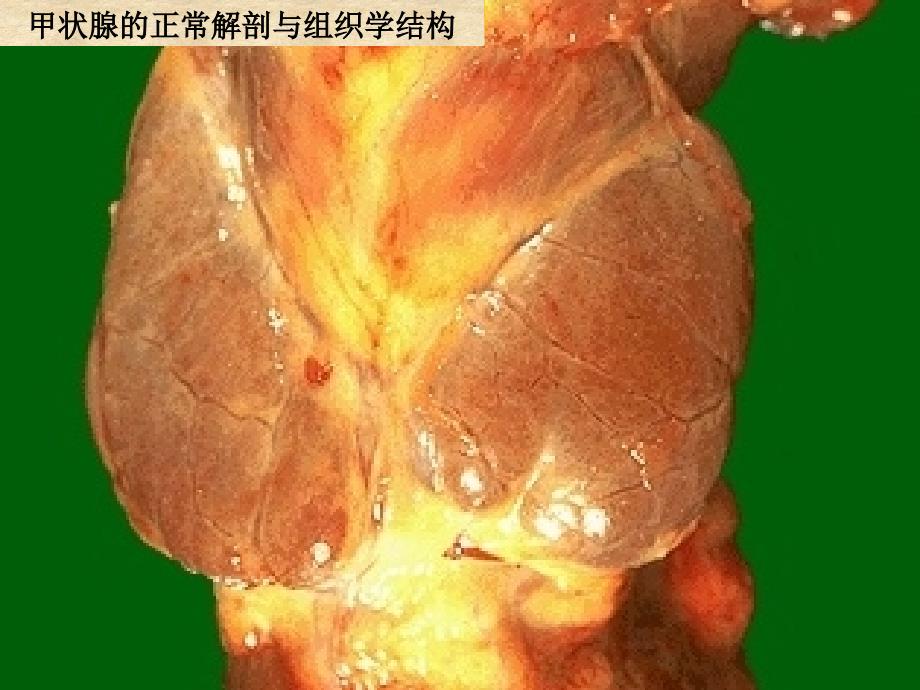 病理学第八版最新课件内分泌系统疾病_第2页