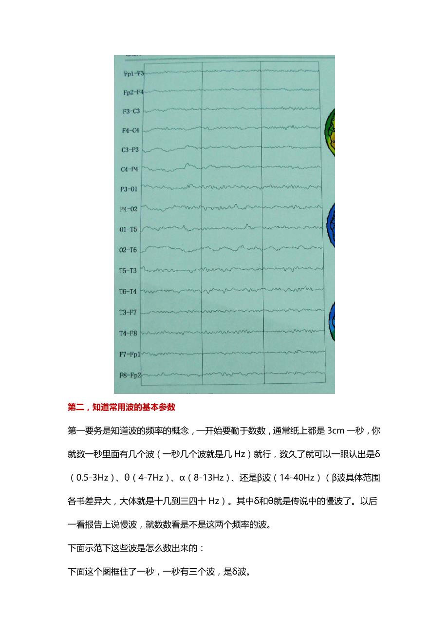 你一定喜欢的脑电图速成_第4页