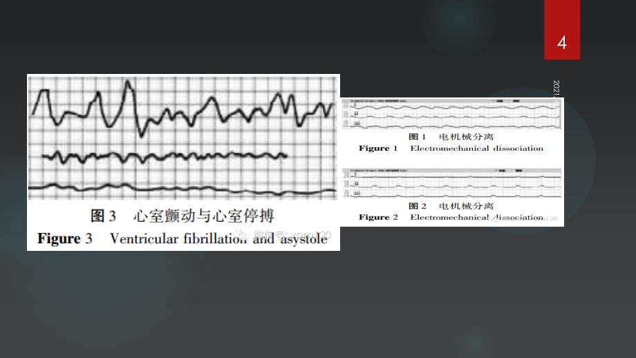 心电图危急值识别文档资料_第4页