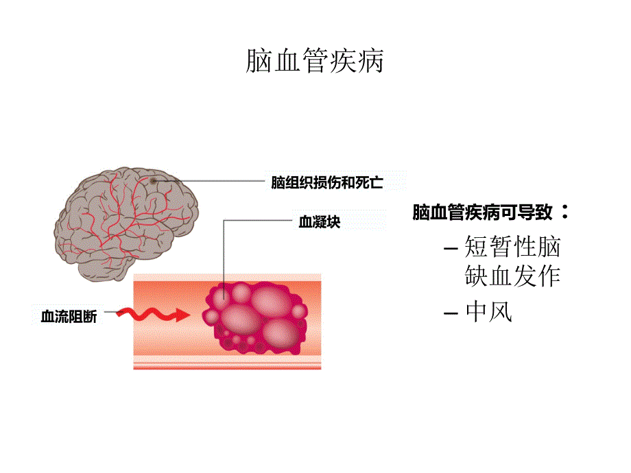 糖尿病急慢性并发症.ppt_第4页