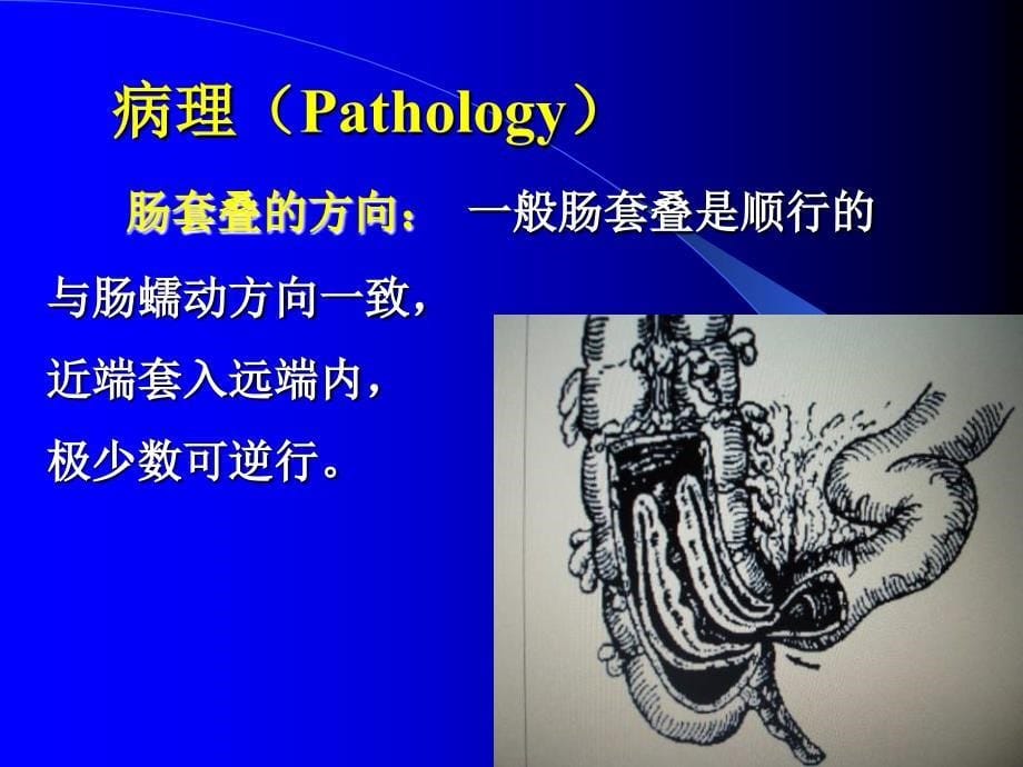 七年制医学课件小儿外科6小儿肠套叠_第5页