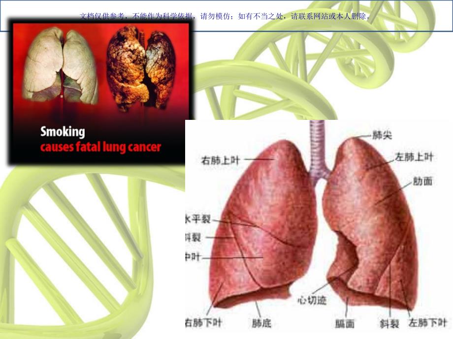 左上肺癌根治术课件_第2页