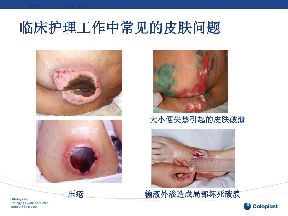 伤口护理观念演变及应用课件_第2页