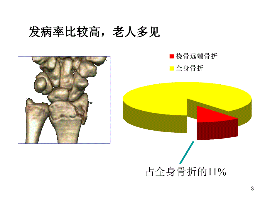 桡骨远端骨折课件_第3页