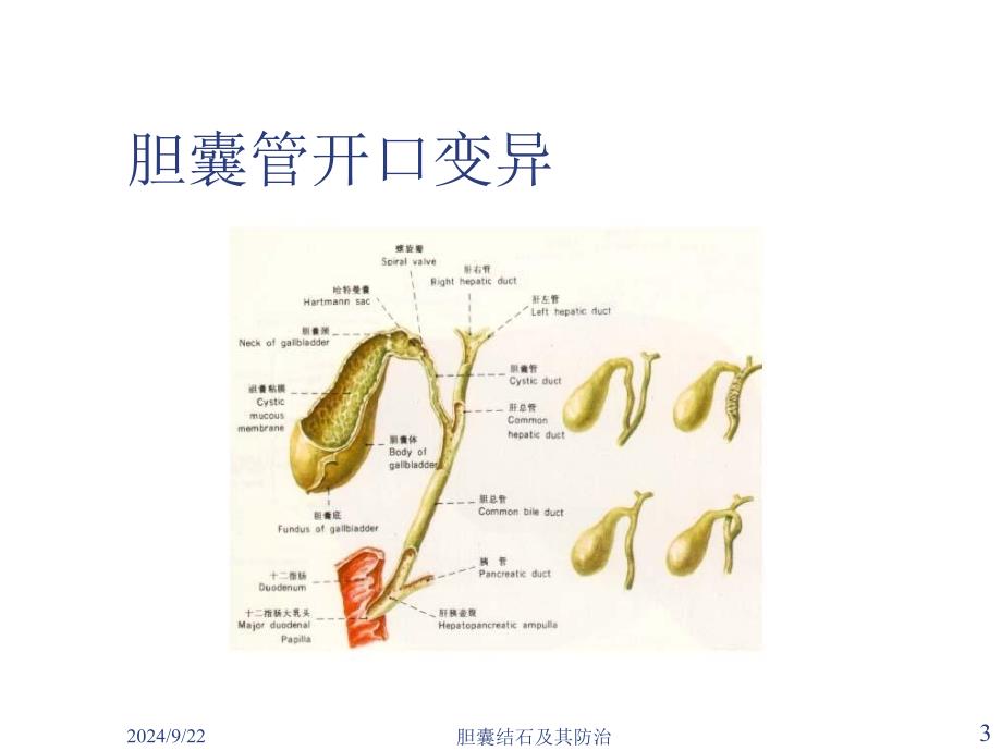 胆囊结石及其防治课件_第3页