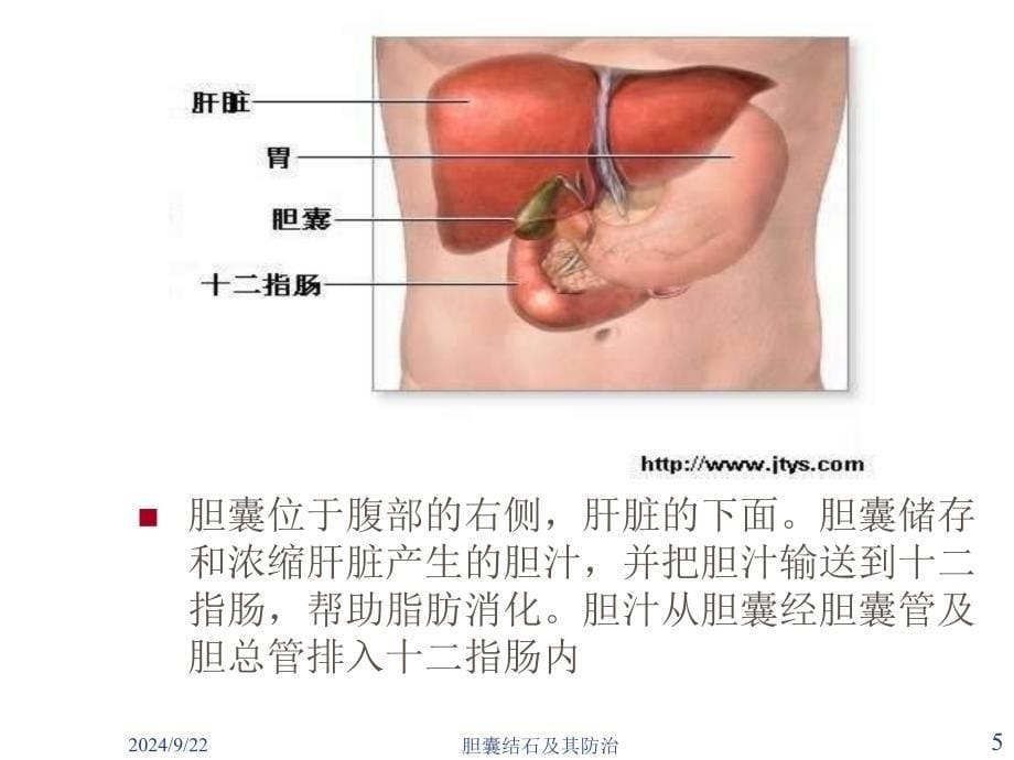 胆囊结石及其防治课件_第5页