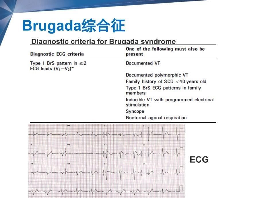 医学交流课件：ICD在离子通道疾病的应用_第5页