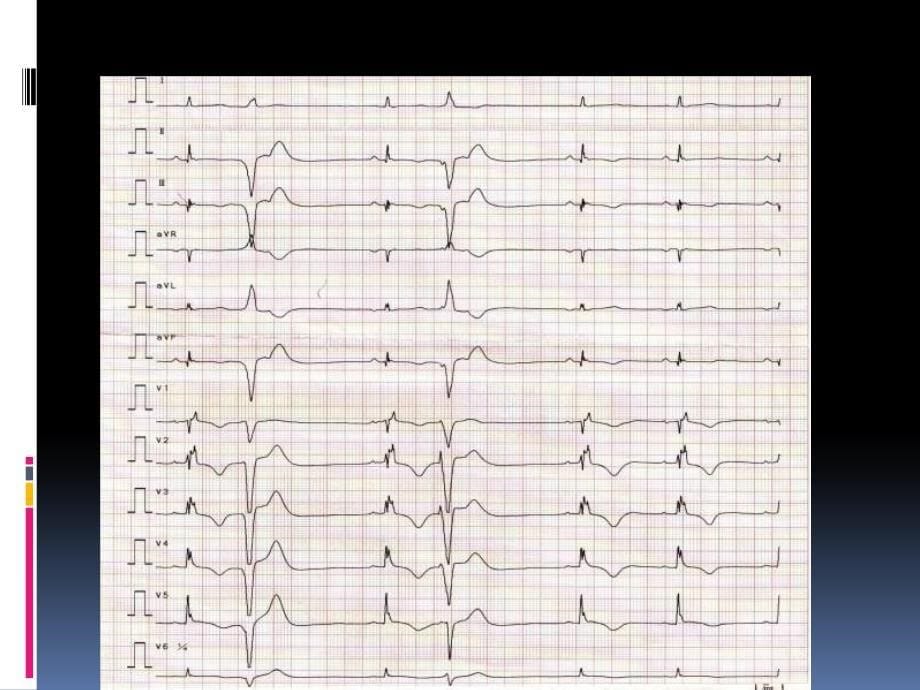 cabg心外膜icd高远_第5页