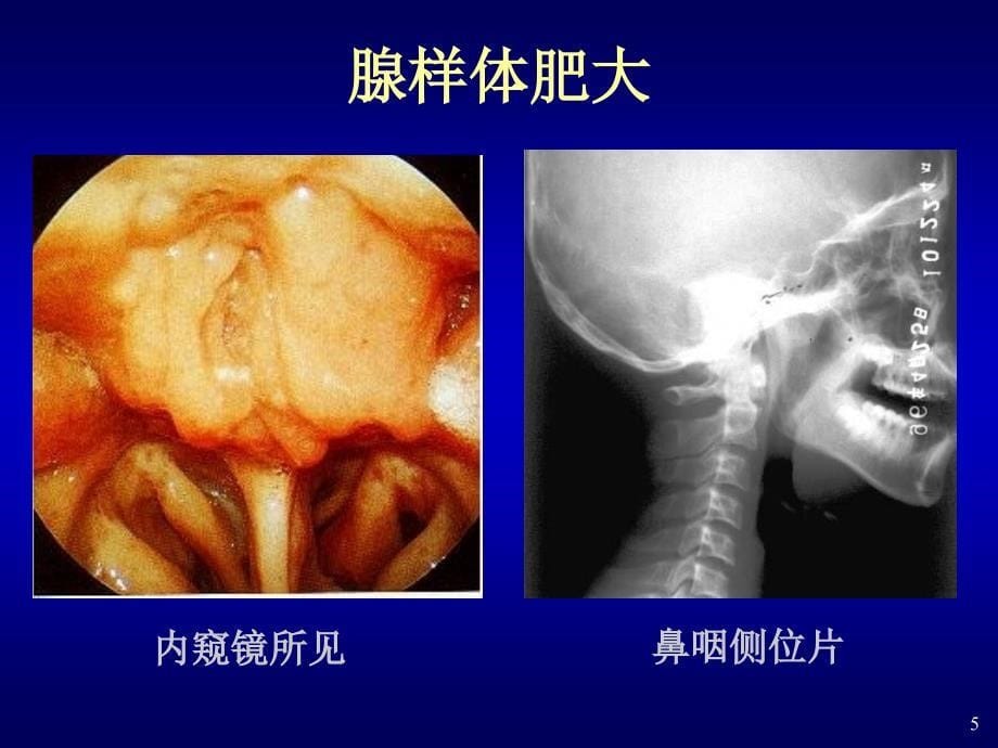 分泌性中耳炎SecretoyotitismediaSOM_第5页