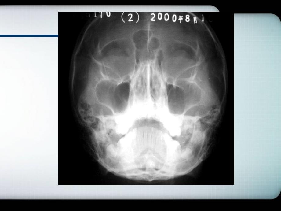 颌面骨折PPT课件_第3页