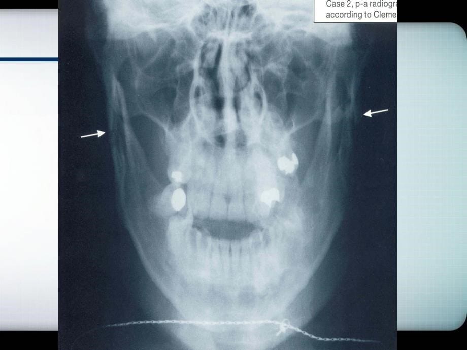 颌面骨折PPT课件_第5页