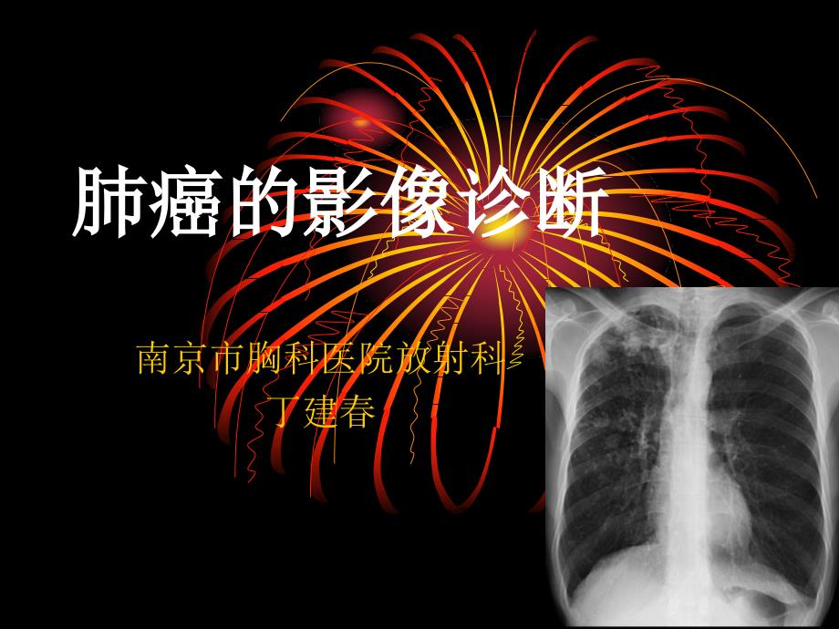 肺癌影像诊断.ppt_第1页