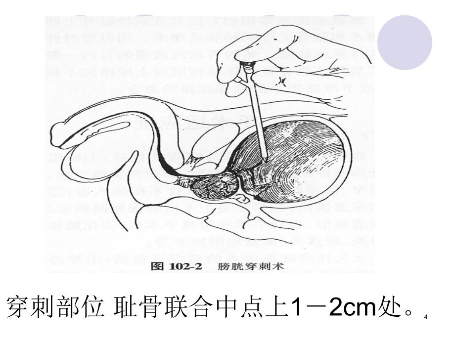 膀胱穿刺及导尿术后健康宣教ppt课件_第4页