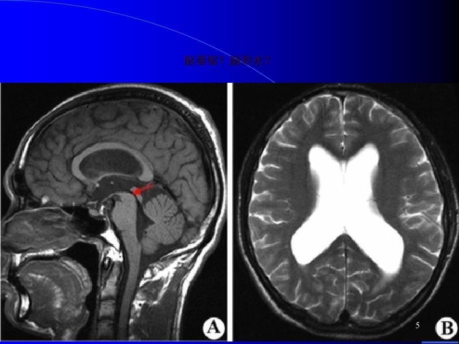 脑积水与脑萎缩的CT和MRI诊断ppt课件_第5页