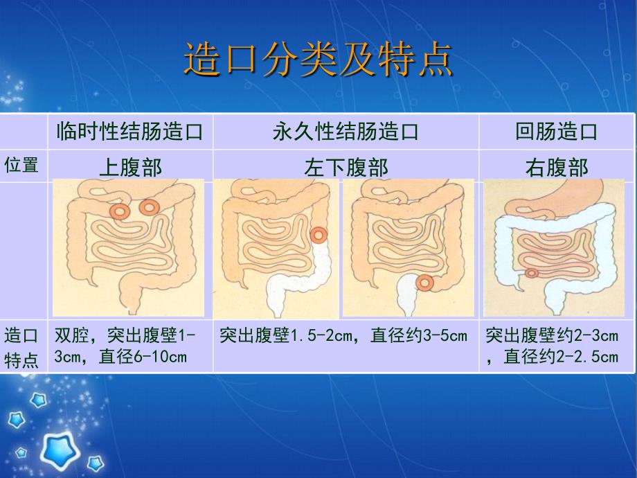 肠造口护理PPT课件_第2页