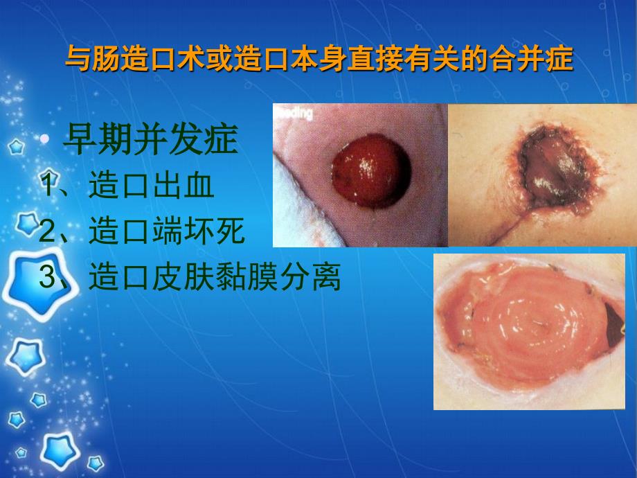 肠造口护理PPT课件_第3页