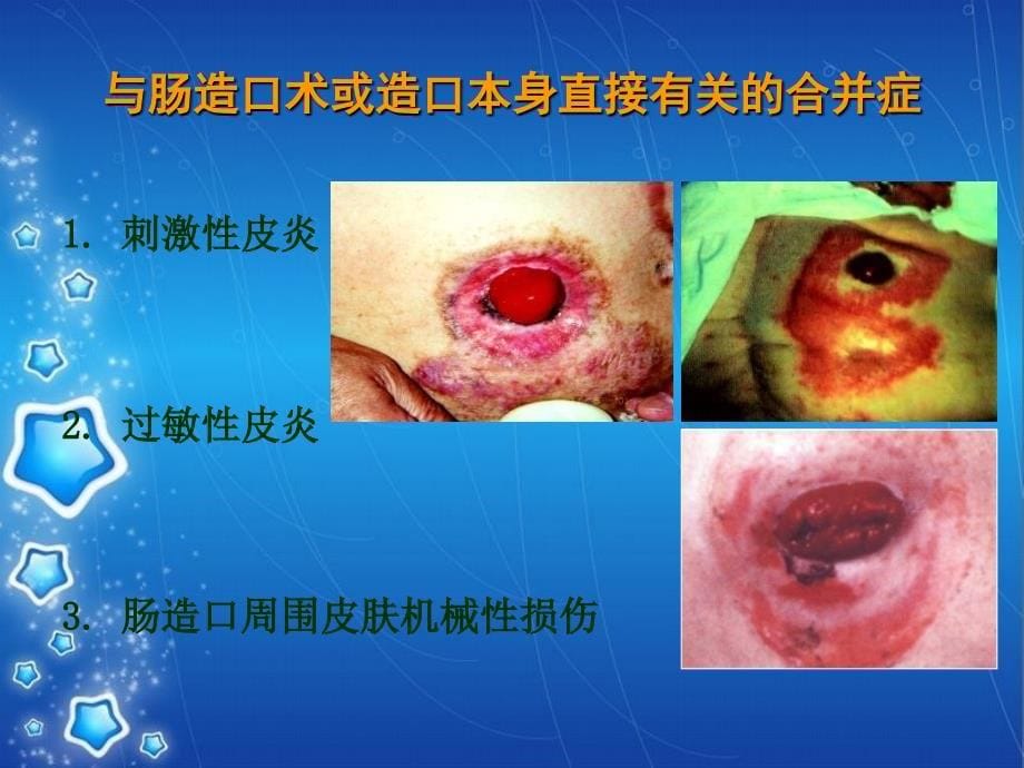 肠造口护理PPT课件_第5页