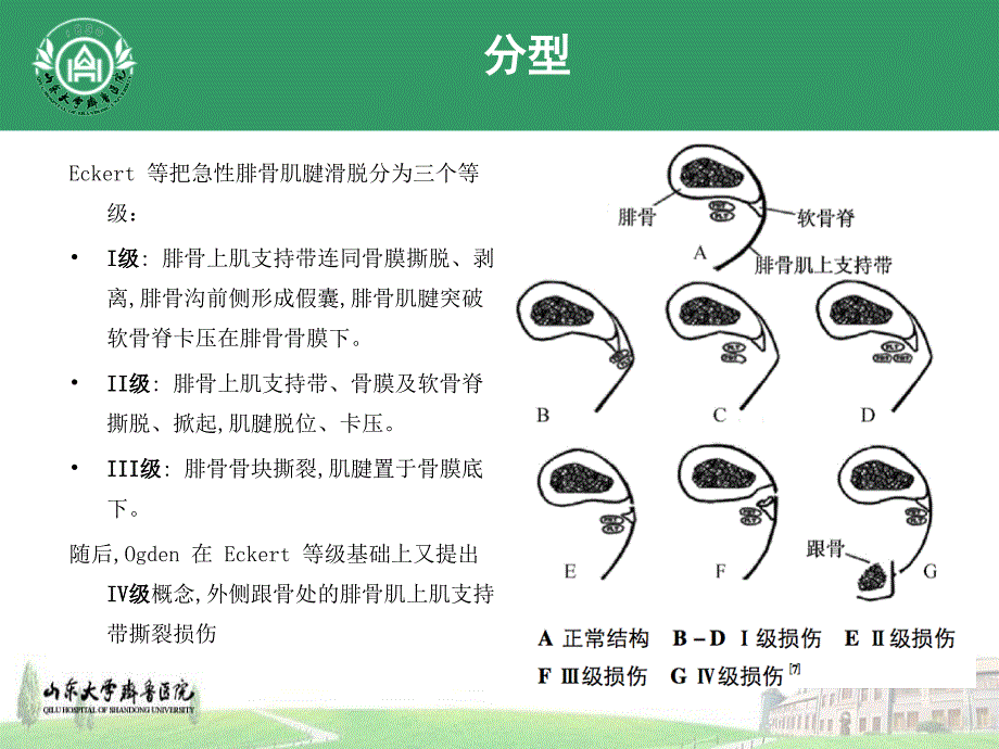 腓骨肌腱滑脱PPT_第4页