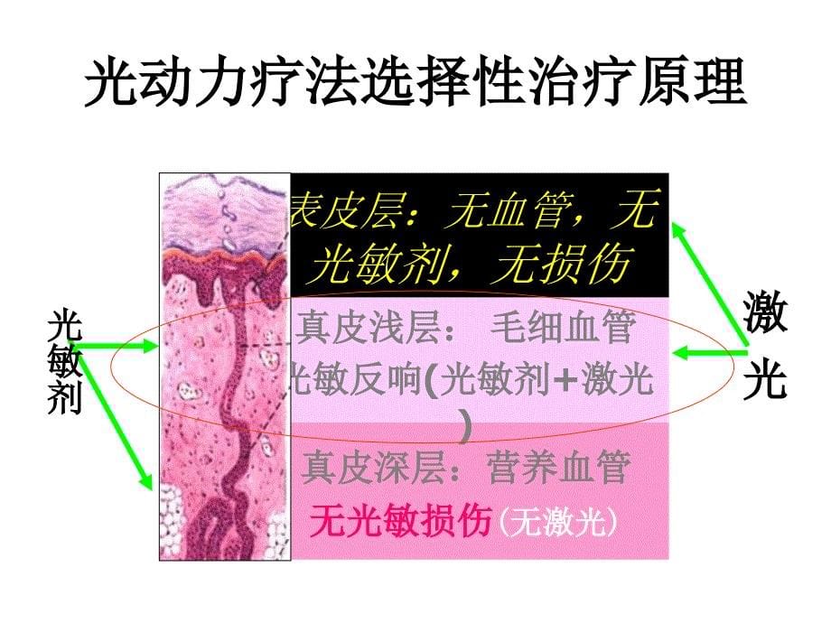 光动力疗法治疗鲜红斑痣_第5页