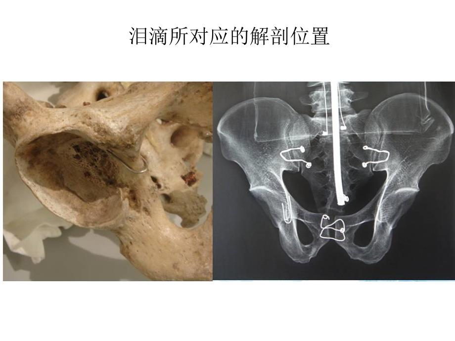 全髋关节置换术中的精确重建_第3页