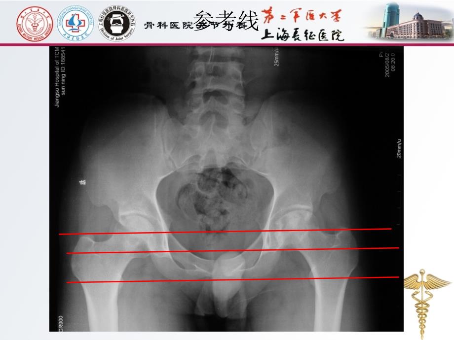 全髋关节置换术中的精确重建_第4页