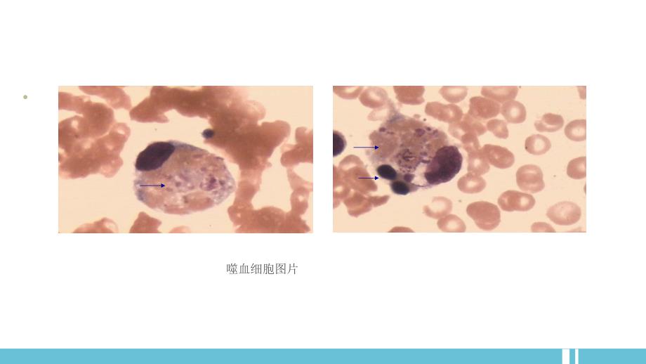 噬血细胞综合征HPS_第3页