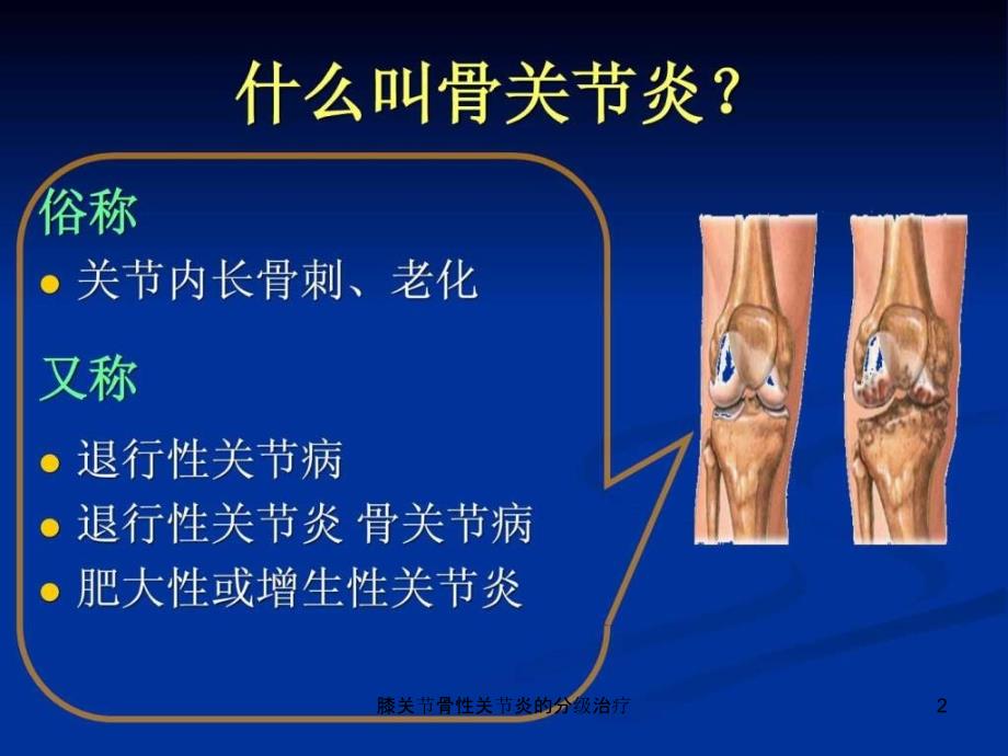 膝关节骨性关节炎的分级治疗课件_第2页