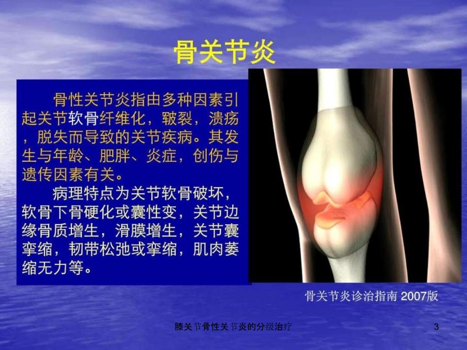 膝关节骨性关节炎的分级治疗课件_第3页