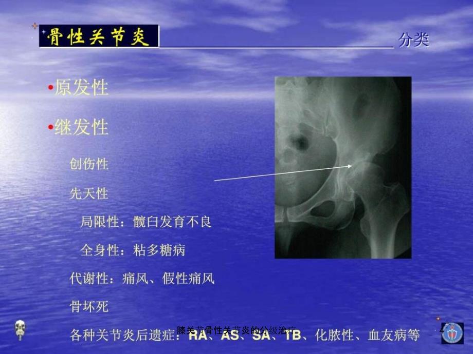 膝关节骨性关节炎的分级治疗课件_第4页