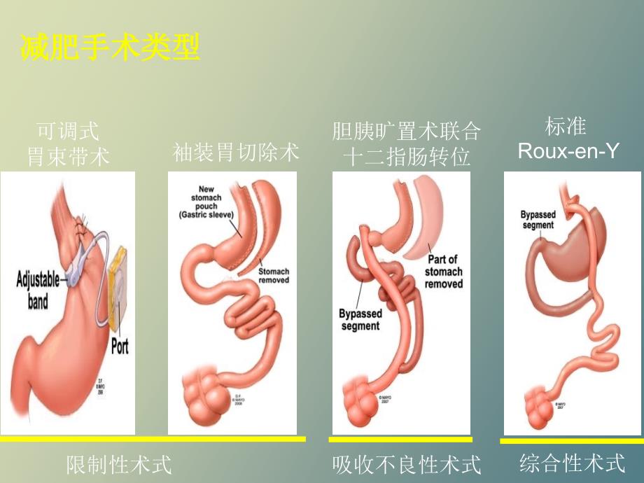 减肥手术后内分泌代谢紊乱及预防_第2页