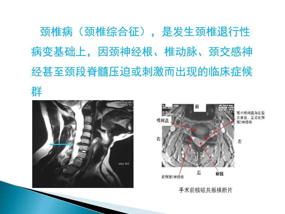 颈椎腰椎病科普讲座.ppt_第3页