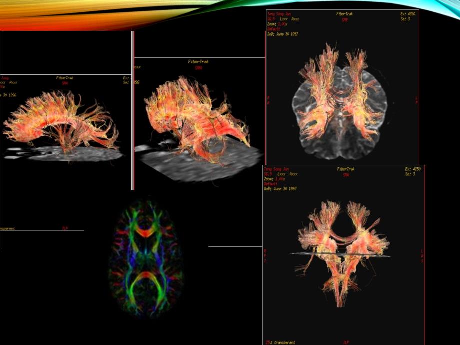 磁共振弥散张量成像讲解.ppt_第3页