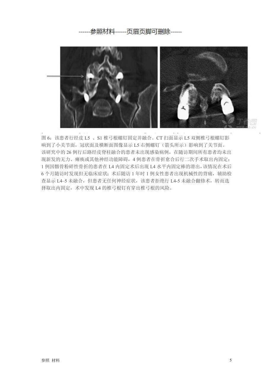 手术技巧：经皮胸、腰椎弓根螺钉置入技术[参照类别]_第5页