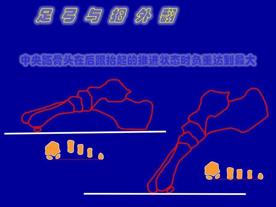 拇外翻足底的生物力学改变ppt课件_第5页