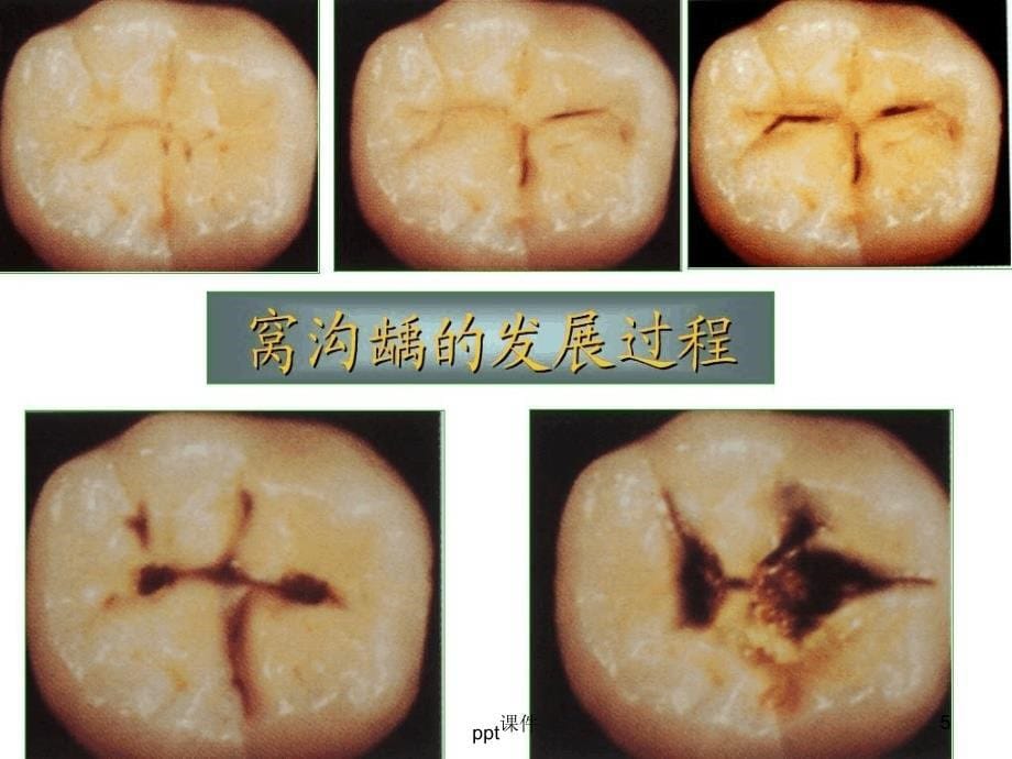 儿童龋齿最新课件_第5页