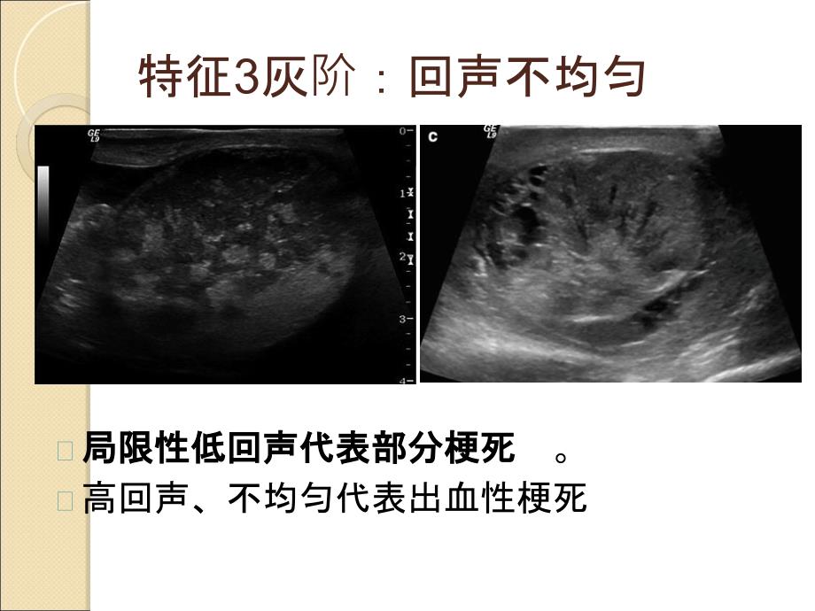 睾丸扭转超声课件_第5页