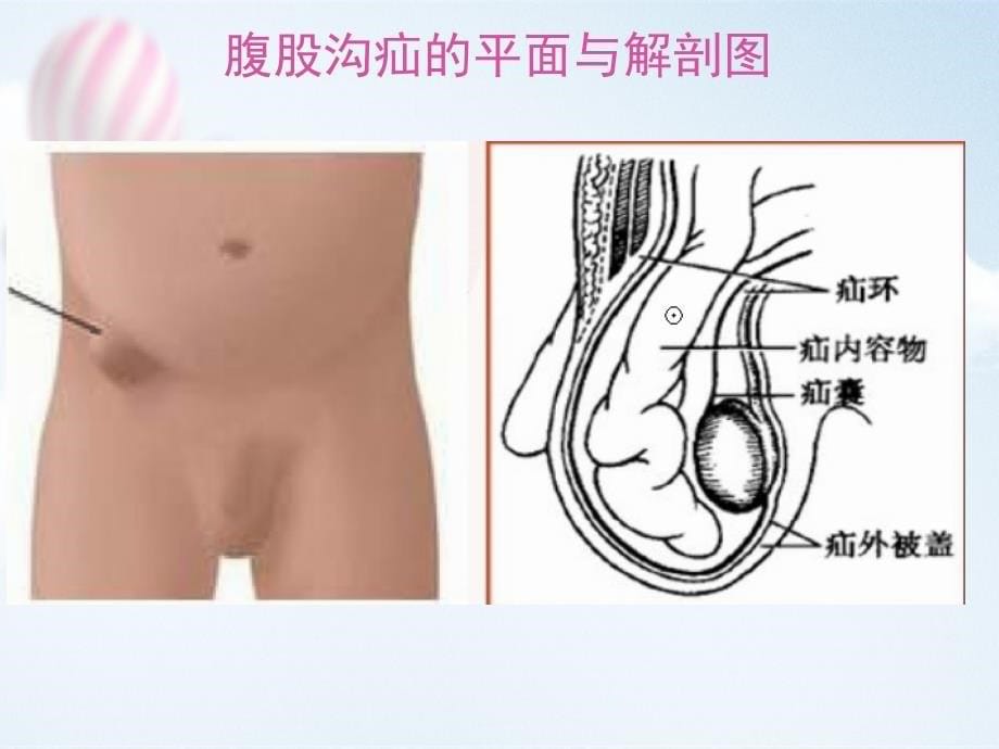 全腹膜外修补术.10.16ppt课件_第5页