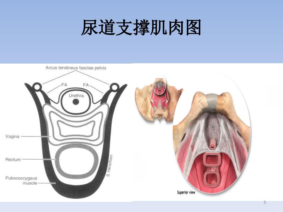 sling手术方式选择的思考_第3页