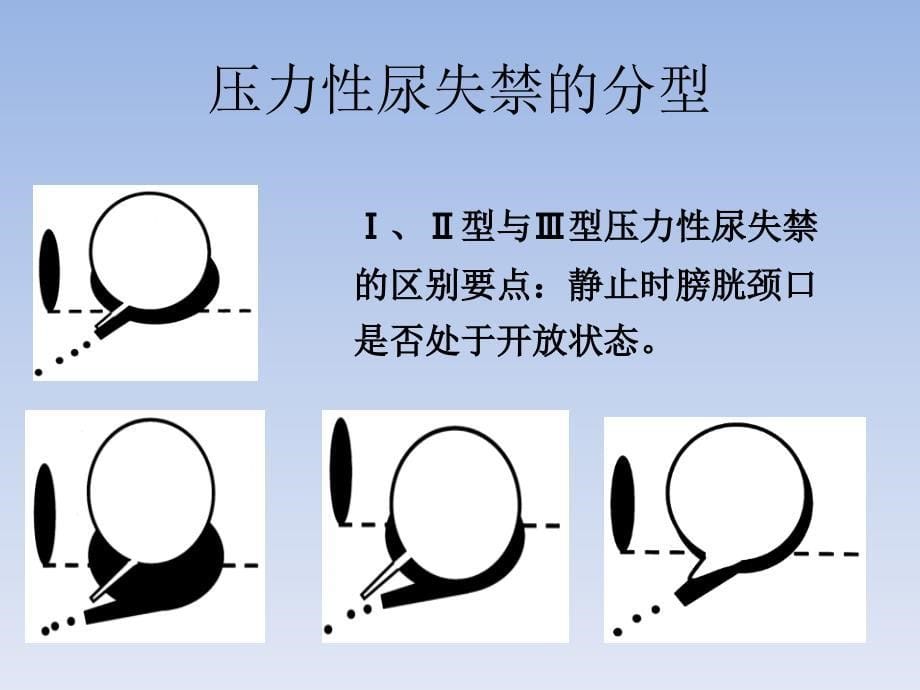 sling手术方式选择的思考_第5页