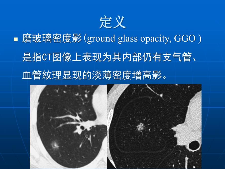 肺磨玻璃密度病变初步探讨-影像FTP课件_第2页