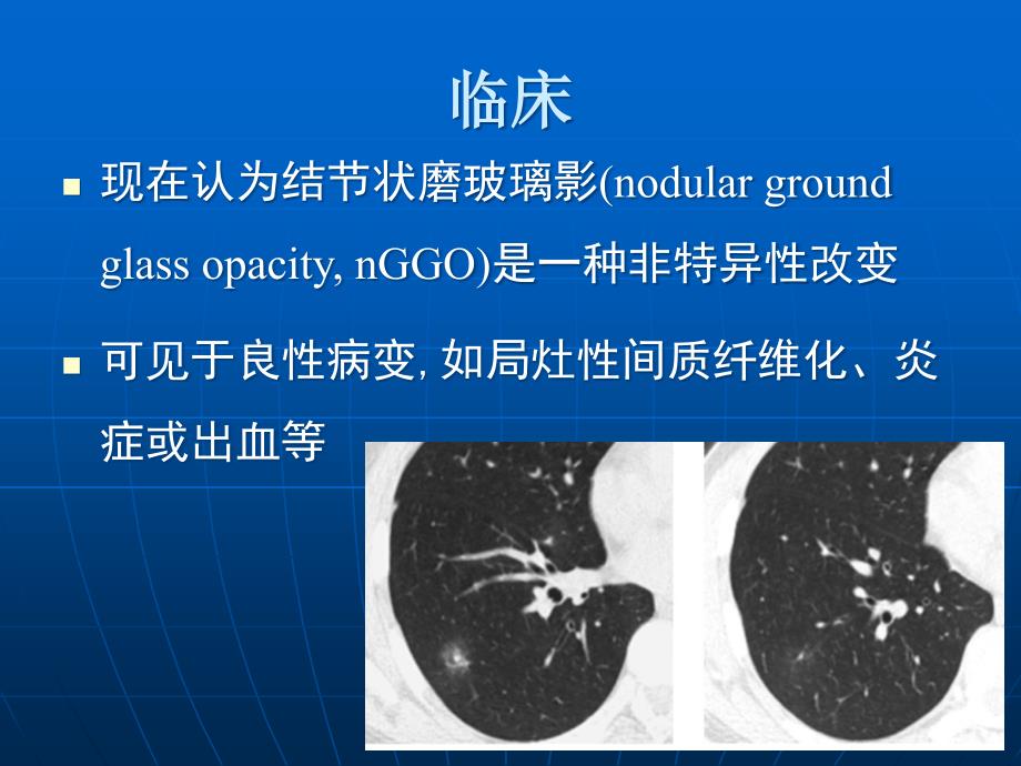 肺磨玻璃密度病变初步探讨-影像FTP课件_第3页