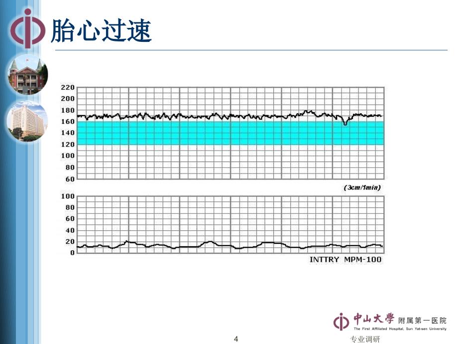 胎监实例分析严选材料_第4页