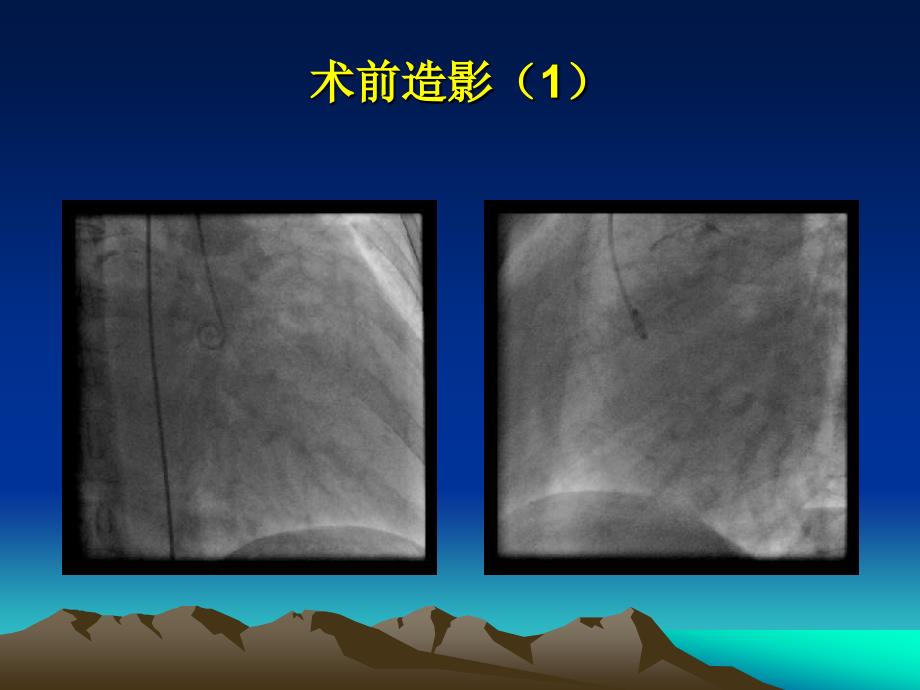 双封堵器介入治疗巨大左冠右房瘘1例胡海波_第3页