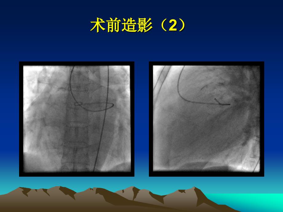 双封堵器介入治疗巨大左冠右房瘘1例胡海波_第4页