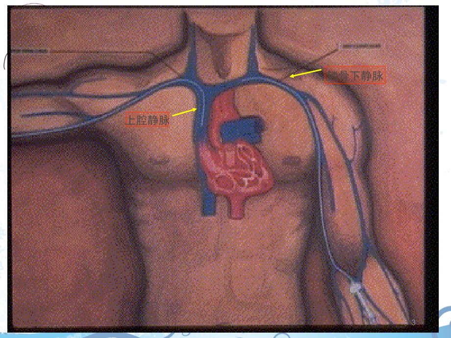 PICC的使用及护理ppt课件_第3页