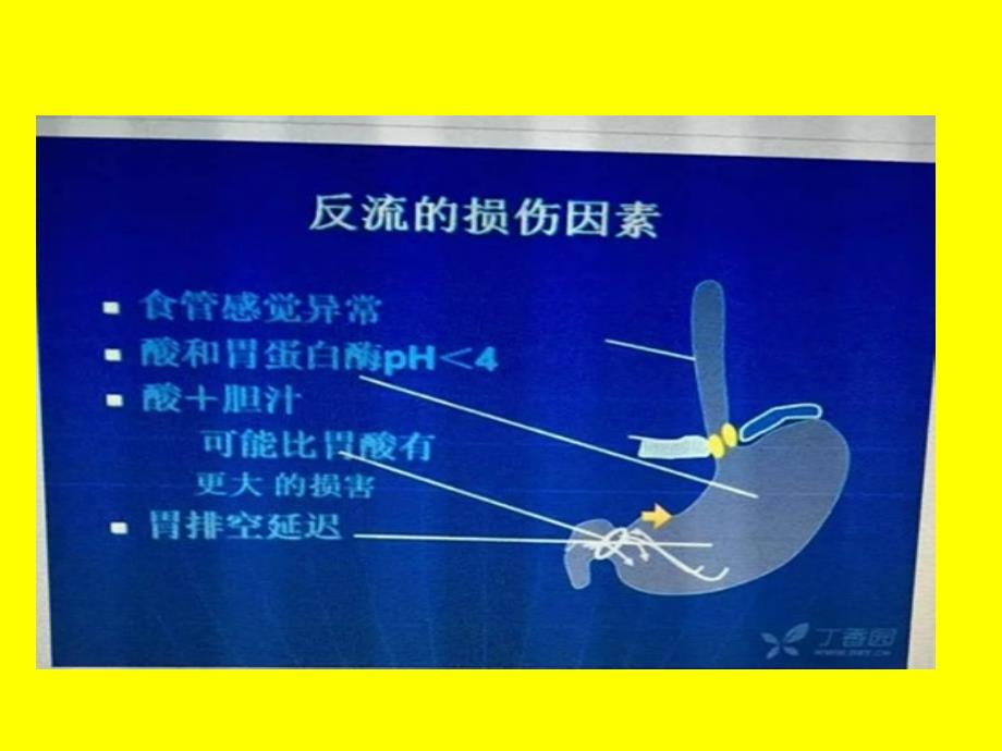 胃食管反流病几个现实问题_第4页