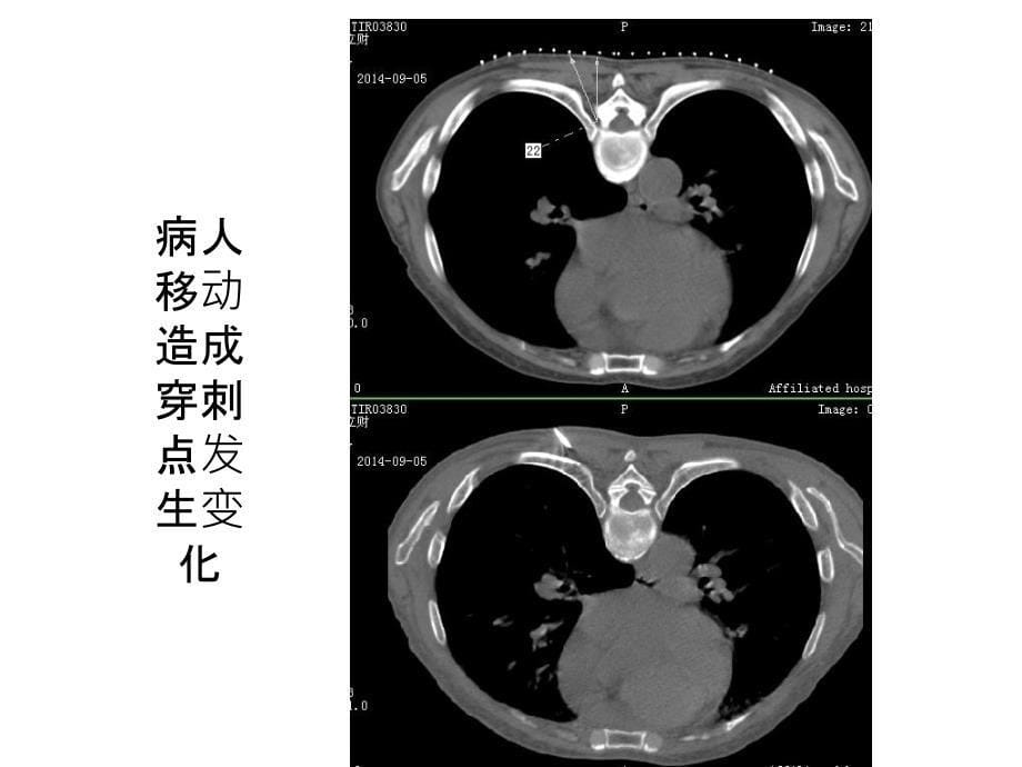 CT导向下介入操作基本的技巧.ppt_第5页